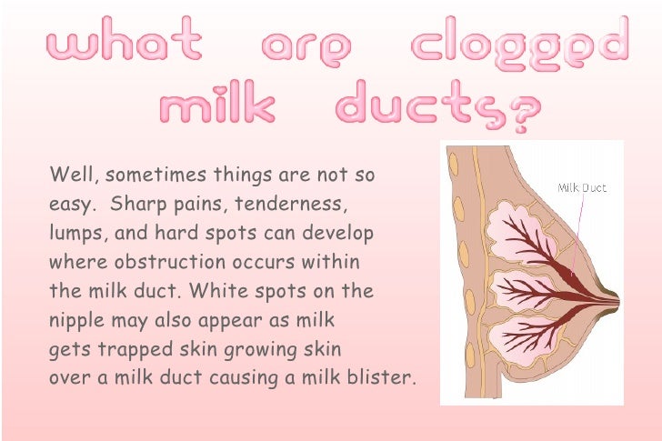 clogged breast ducts Clogged breast ducts